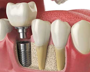Strong Dental Implants