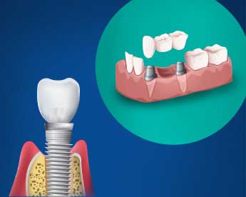 Dental Implant Types
