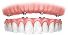 Implant Supported Denture