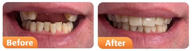 Dental Implants in Michigan Before and After Result Pictures