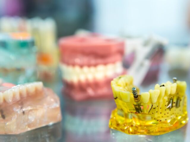 What to Know Before Getting Dental Implants