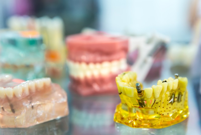 what-to-know-before-getting-dental-implants
