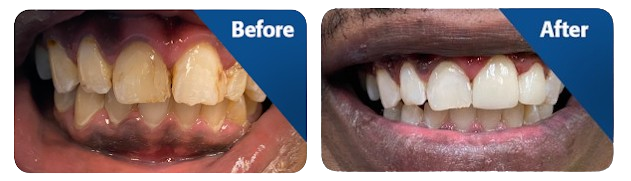 Before and after comparison of teeth whitening results at New You Dental Center in Michigan. The left image shows discolored teeth before treatment, while the right image displays significantly whiter and brighter teeth after the procedure.