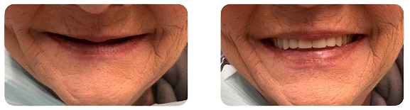 Dentures Before and After Results at New You Dental Center