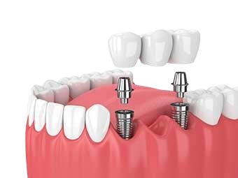 Multiple Tooth Implants