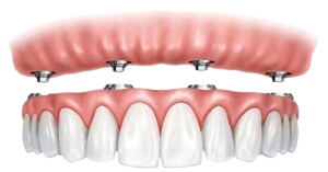 Implant-Supported Denture