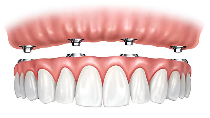 Implant-Supported Dentures