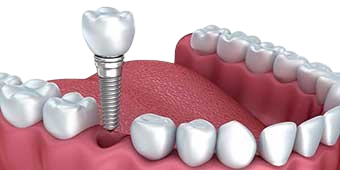 Single Tooth Implant