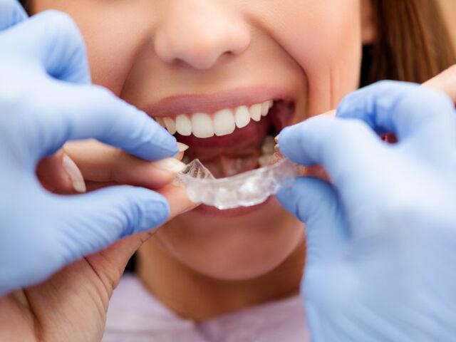 Dentist fitting Invisalign aligners for a patient