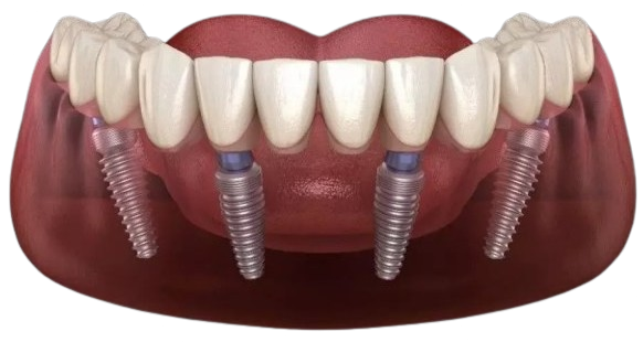 All-On-4 Dental Implants