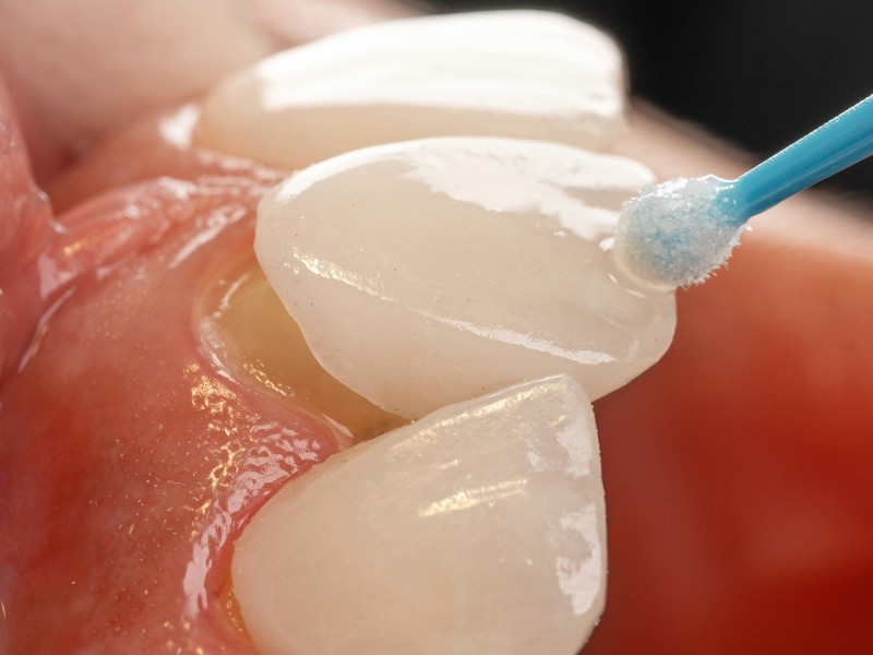 do-you-need-dental-veneers-or-dental-bonding-what-patients-should-consider