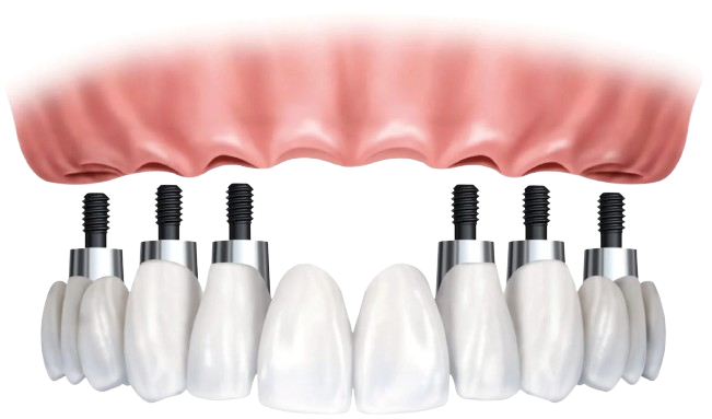 Full Arch Dental Implants