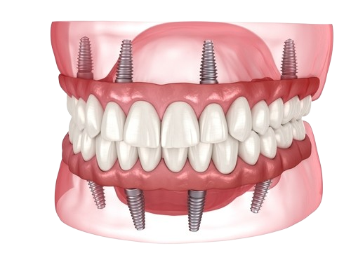 Full Mouth Dental Implants